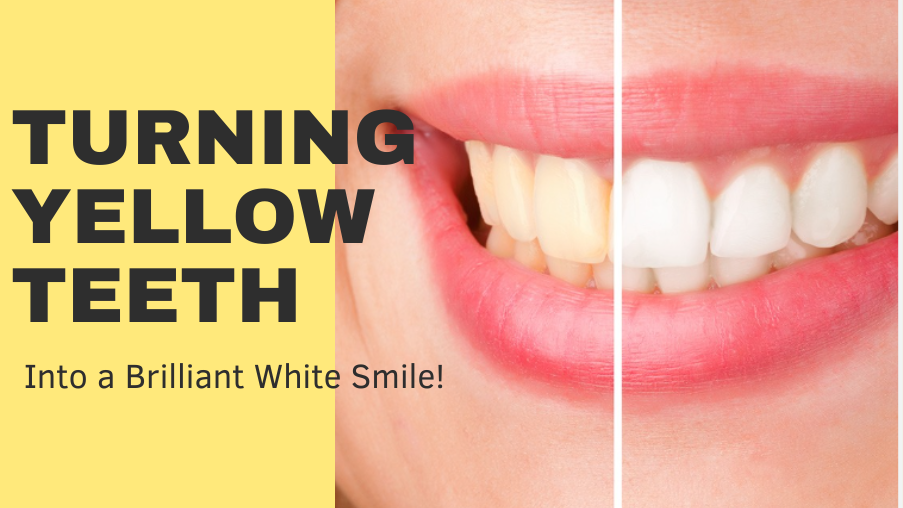 how-to-transform-yellow-teeth-into-dazzling-white-smile