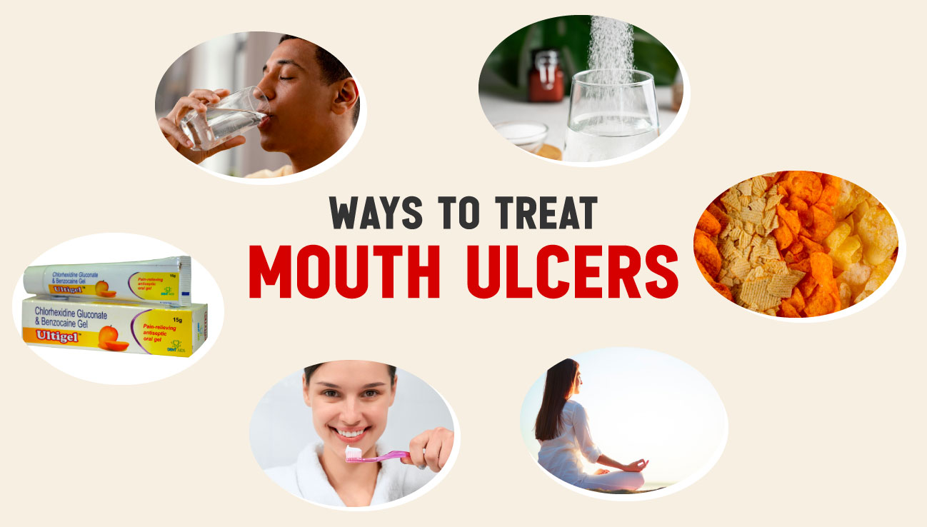 Mouth ulcer cure